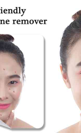 Pimple Remover, Eraser - Face Beauty Maker 4