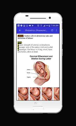 Obstetrics Mnemonics 4