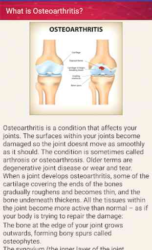 Osteoarthritis Joint Pain Treatment Home Remedies 2