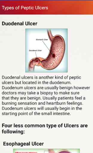 Peptic Ulcers Treatment & Help for Stomach Ulcers 3