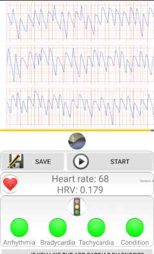 Diagnóstico cardíaco>frecuencia cardíaca, arritmia 4
