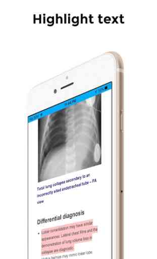 CXR FlashCards - Reference app for Chest X-rays 3