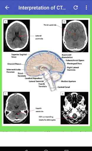 CT Brain Basic Interpretation 3