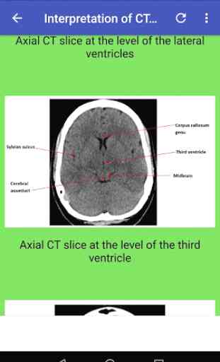 CT Brain Basic Interpretation 4
