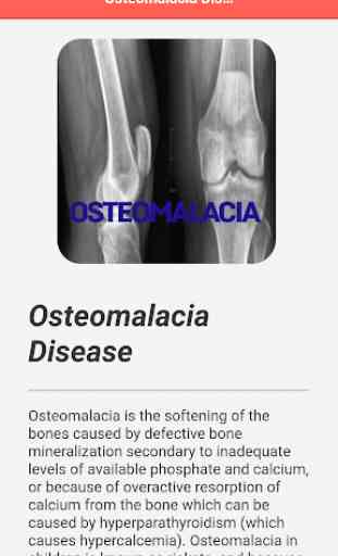 Osteomalacia Disease 4
