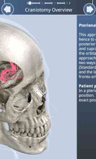 Pterional Craniotomy 2