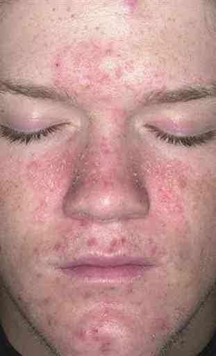 Eczema in the skin 1