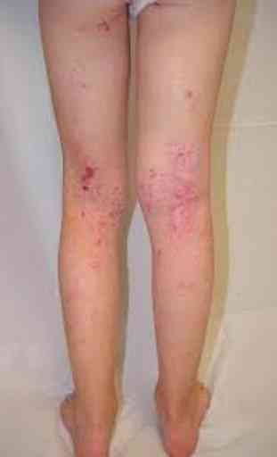 Eczema in the skin 2