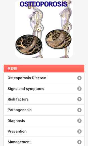 Osteoporosis Disease 3